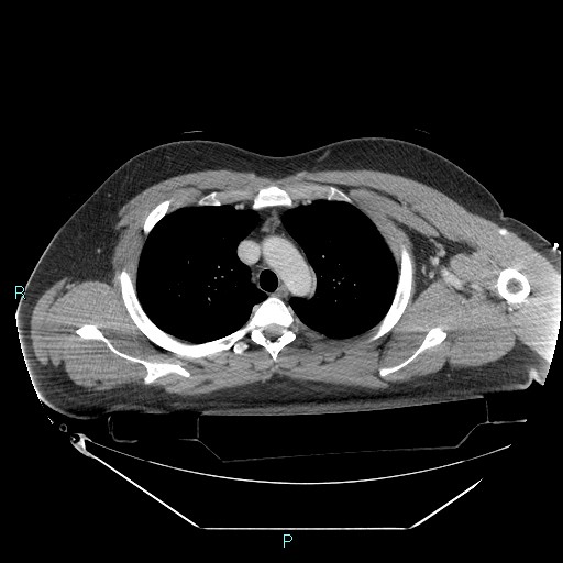 File:Bronchial carcinoid tumor (Radiopaedia 78272-90870 C 37).jpg