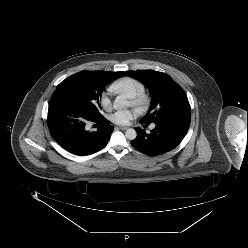 Bronchial carcinoid tumor (Radiopaedia 78272-90870 C 65).jpg