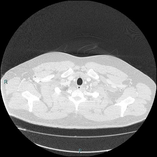 Bronchial carcinoid tumor (Radiopaedia 78272-90875 Axial lung window 1).jpg