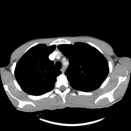 File:Bronchial carcinoid tumor causing right lower lobe collapse (Radiopaedia 83495-98594 A 10).jpg