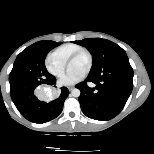 Bronchial carcinoid tumor causing right lower lobe collapse (Radiopaedia 83495-98594 A 32).jpg