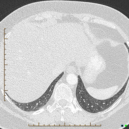 Bronchial diverticula (Radiopaedia 79512-92676 Axial lung window 181).jpg
