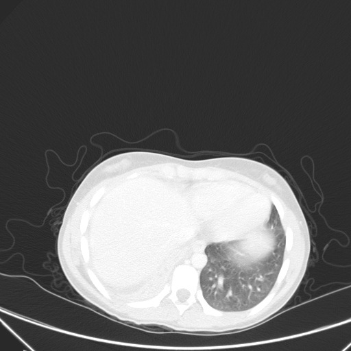 Bronchial mucoepidermoid carcinoma (Radiopaedia 57023-63895 Axial lung window 89).jpg