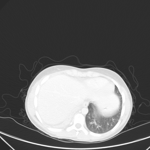 Bronchial mucoepidermoid carcinoma (Radiopaedia 57023-63895 Axial lung window 93).jpg