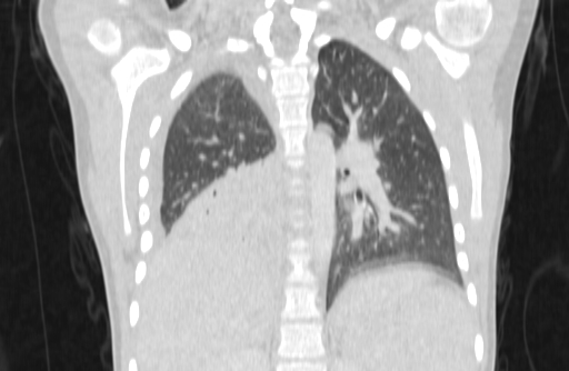 Bronchial mucoepidermoid carcinoma (Radiopaedia 57023-63895 Coronal lung window 49).jpg