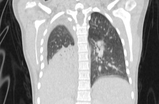 Bronchial mucoepidermoid carcinoma (Radiopaedia 57023-63895 Coronal lung window 59).jpg