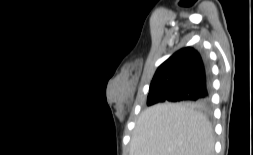 Bronchial mucoepidermoid carcinoma (Radiopaedia 57023-63895 Sagittal 5).jpg