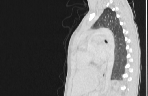 Bronchial mucoepidermoid carcinoma (Radiopaedia 57023-63895 Sagittal lung window 110).jpg