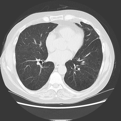 File:Bronchial stenosis - lung transplant (Radiopaedia 73133-83848 Axial lung window 38).jpg