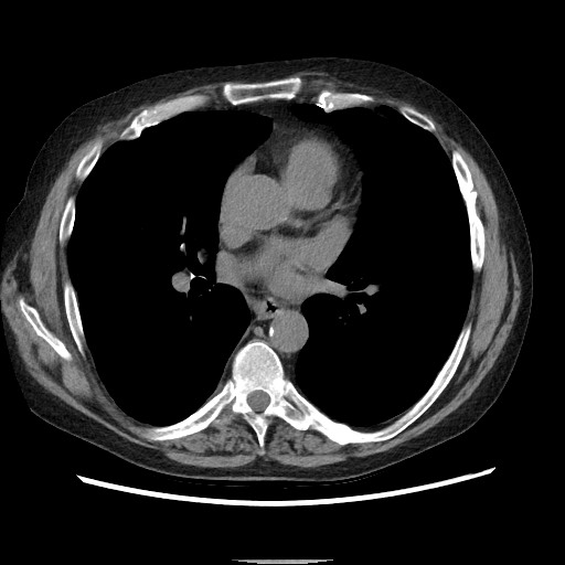 Bronchial stenosis - lung transplant (Radiopaedia 73133-83848 Axial non-contrast 35).jpg