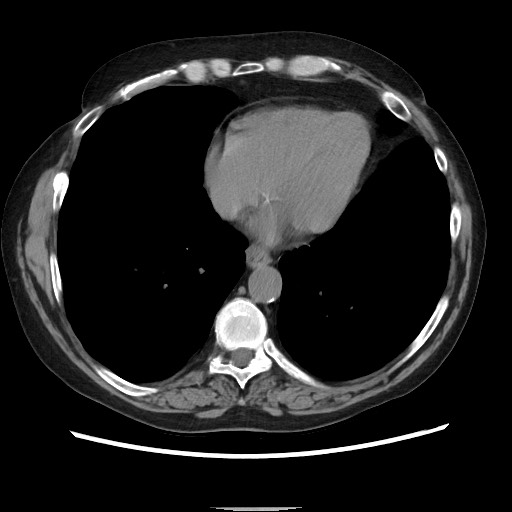 Bronchial stenosis - lung transplant (Radiopaedia 73133-83848 Axial non-contrast 44).jpg