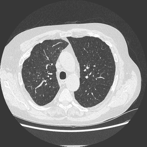 File:Bronchial stenosis - lung transplant (Radiopaedia 73133-83848 B 12).jpg