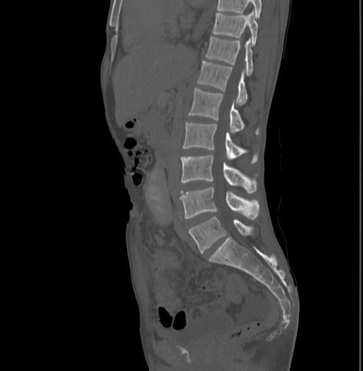 Bronchiectasis in Crohn disease (Radiopaedia 60311-67977 Sagittal bone window 118).jpg
