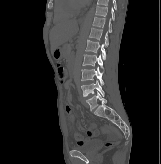 Bronchiectasis in Crohn disease (Radiopaedia 60311-67977 Sagittal bone window 138).jpg