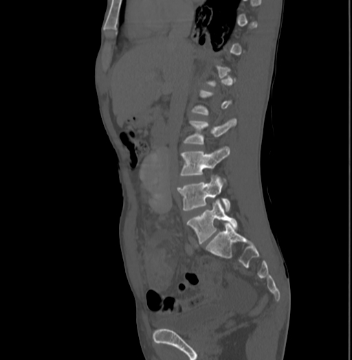 File:Bronchiectasis in Crohn disease (Radiopaedia 60311-67977 Sagittal bone window 98).jpg