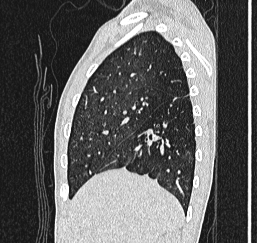Bronchiolitis obliterans (Radiopaedia 71538-81897 Sagittal lung window 14).jpg