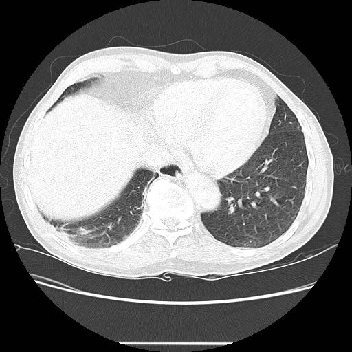 File:Bronchocele (Radiopaedia 17097-16795 Axial lung window 92).jpg