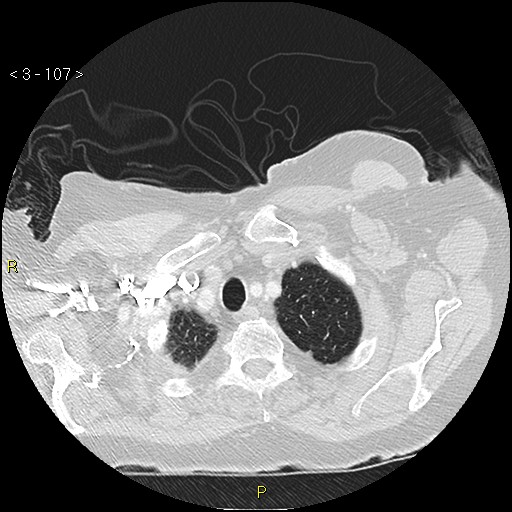 Bronchogenic carcinoma as an incidental finding (Radiopaedia 16453-16130 Axial lung window 107).jpg