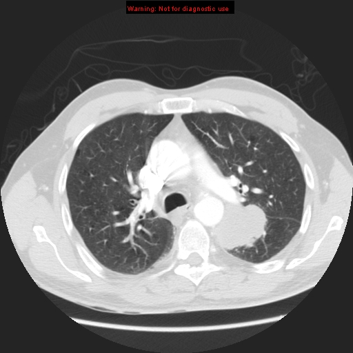 File:Bronchogenic carcinoma brain metastasis (Radiopaedia 9286-105832 Axial lung window 11).jpg