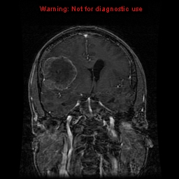 File:Bronchogenic carcinoma brain metastasis (Radiopaedia 9286-9969 Coronal T1 20).jpg