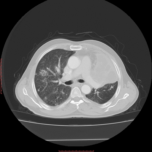File:Bronchogenic carcinoma with left atrial large deposit - T4N3M1a (Radiopaedia 42316-45428 Axial lung window 13).jpg
