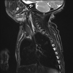 File:Bronchogenic cyst (Radiopaedia 27207-27380 Sagittal STIR 1).jpg