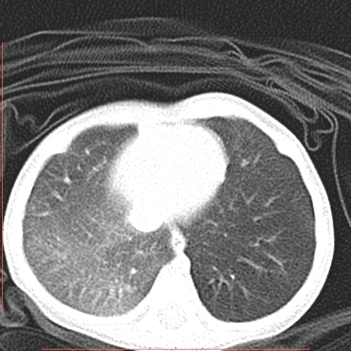 Bronchogenic cyst (Radiopaedia 78599-91409 Axial lung window 114).jpg