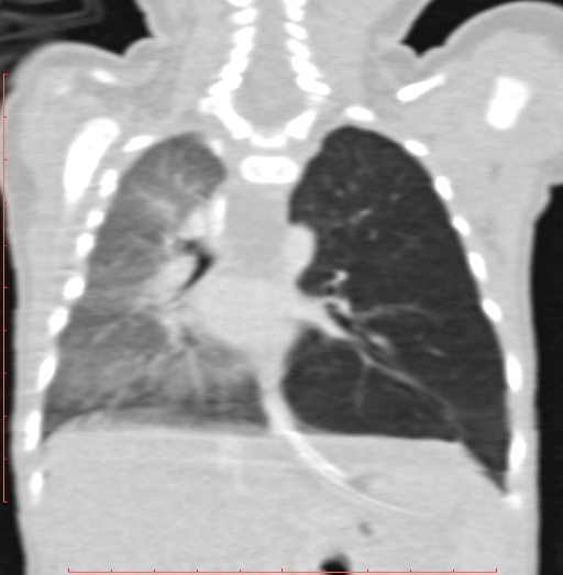 Bronchogenic cyst (Radiopaedia 78599-91409 Coronal lung window 140).jpg