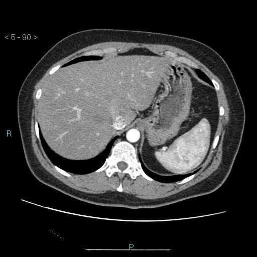 Bronchogenic cyst - posterior mediastinal (Radiopaedia 43885-47364 A 52).jpg