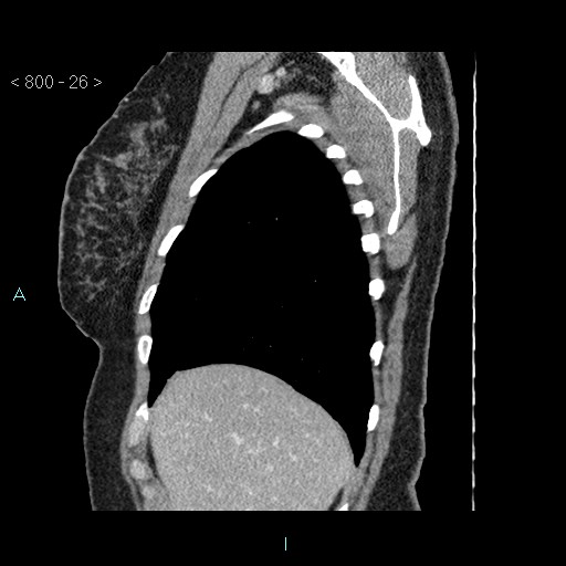 Bronchogenic cyst - posterior mediastinal (Radiopaedia 43885-47364 B 17).jpg