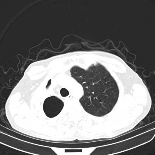 Bronchopleural fistula - postoperative complication (Radiopaedia 21020-20947 Axial lung window 14).jpg