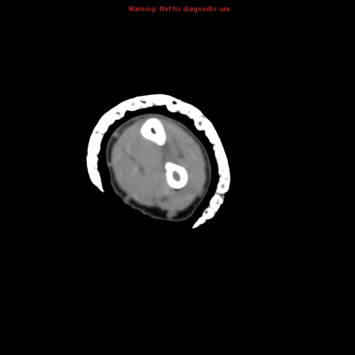 Brown tumor (Radiopaedia 12460-12694 Axial non-contrast 90).jpg