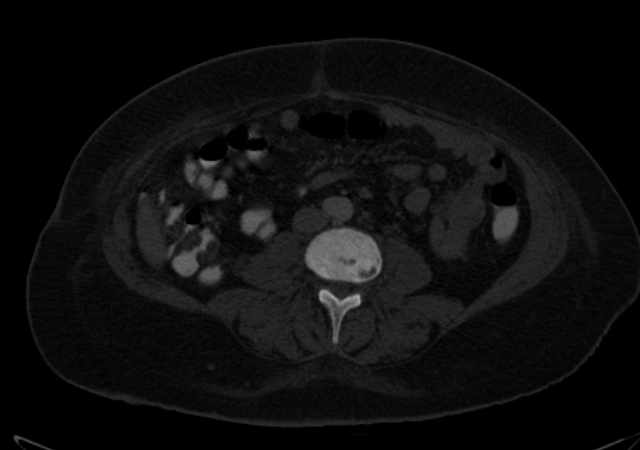 Brown tumors compressing the spinal cord (Radiopaedia 68442-77988 G 70).jpg