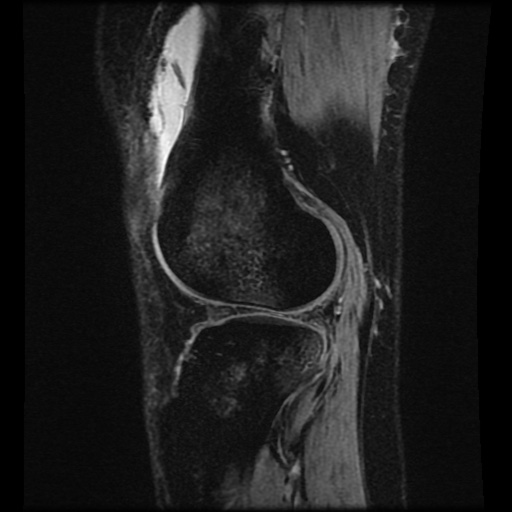 File:Bucket handle meniscus tear (Radiopaedia 56916-63751 H 19).jpg