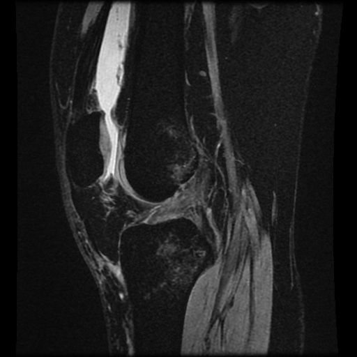 File:Bucket handle meniscus tear (Radiopaedia 56916-63751 H 41).jpg