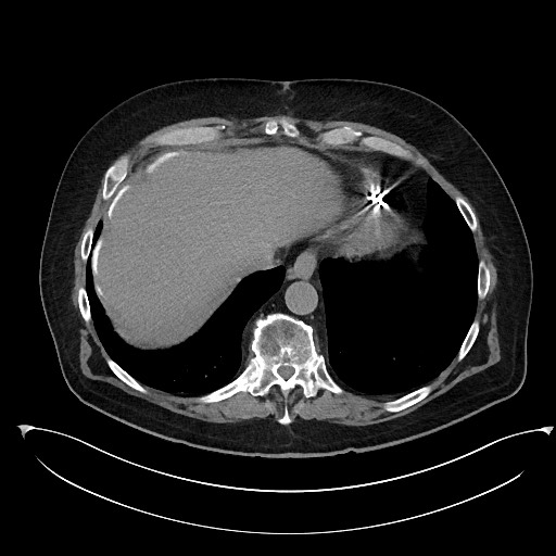 File:Buried bumper syndrome - gastrostomy tube (Radiopaedia 63843-72577 Axial Inject 13).jpg
