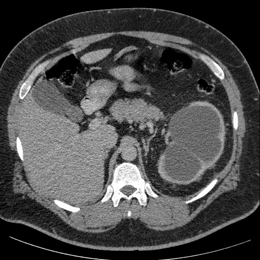 Burned-out testicular seminoma - retroperitoneal nodal metastases (Radiopaedia 62872-71245 A 20).jpg