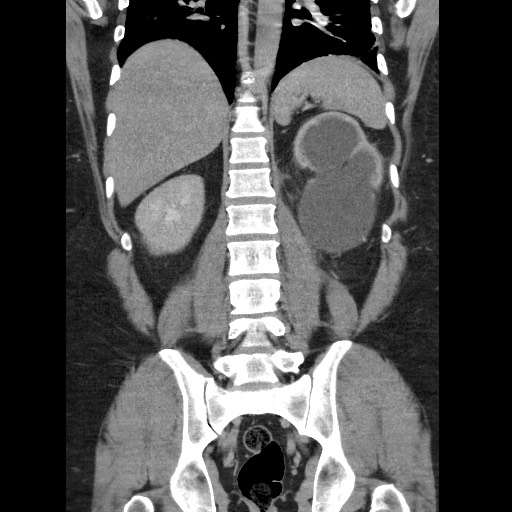 File:Burned-out testicular seminoma - retroperitoneal nodal metastases (Radiopaedia 62872-71245 B 47).jpg
