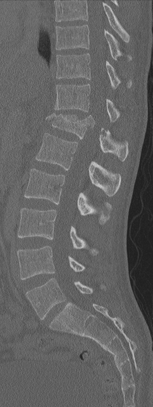 Burst fracture - T12 with conus compression (Radiopaedia 56825-63647 Sagittal bone window 42).png