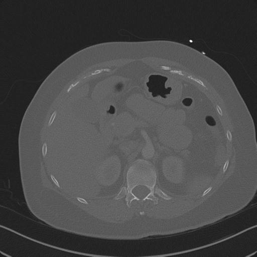 Burst fracture - thoracic spine (Radiopaedia 30238-30865 Axial bone window 95).jpg