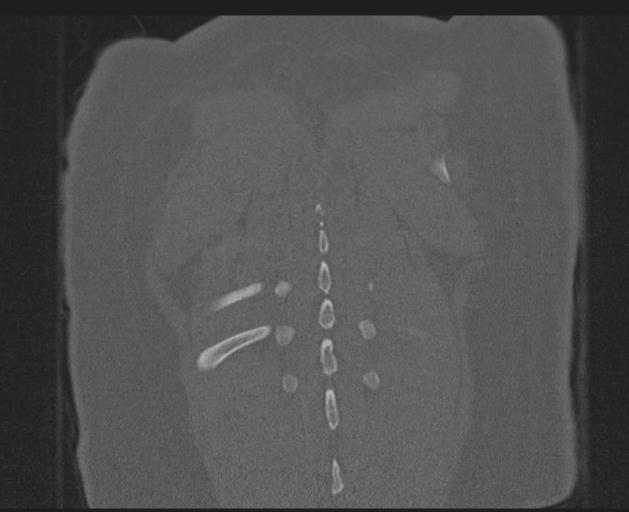 Burst fracture - thoracic spine (Radiopaedia 30238-30865 Coronal bone window 148).jpg