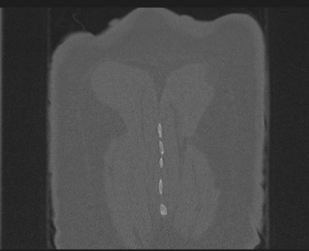 File:Burst fracture - thoracic spine (Radiopaedia 30238-30865 Coronal bone window 155).jpg