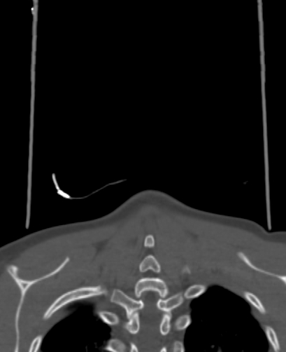 Butterfly vertebra (Radiopaedia 77903-90209 Coronal bone window 106).jpg