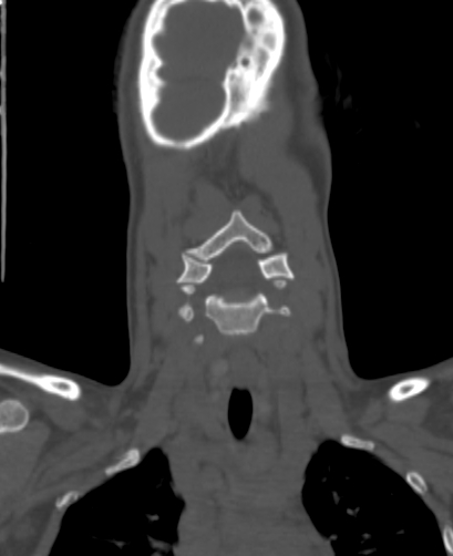 Butterfly vertebra (Radiopaedia 77903-90209 Coronal bone window 3).jpg