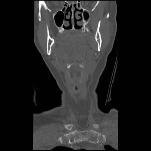 C1 anterior arch (plough) fracture - type 1 (Radiopaedia 76181-87720 Coronal bone window 87).jpg