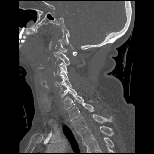 File:C1 anterior arch (plough) fracture - type 1 (Radiopaedia 76181-87720 Sagittal bone window 48).jpg