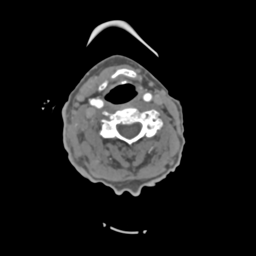 File:C2 fracture with vertebral artery dissection (Radiopaedia 37378-39200 A 134).png