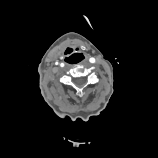 C2 fracture with vertebral artery dissection (Radiopaedia 37378-39200 A 138).png
