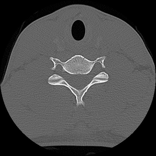 File:C5 facet fracture (Radiopaedia 58374-65499 Axial bone window 64).jpg