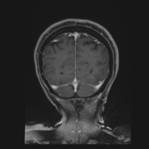 CNS lymphoma with steroid response (Radiopaedia 37980-39921 Coronal T1 C+ 42).png